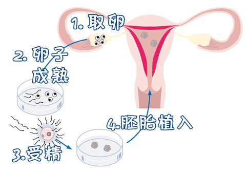 极光生殖